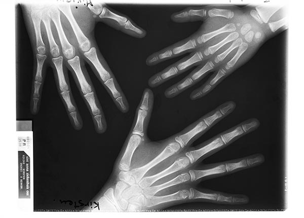 Röntgenfoto drie handen